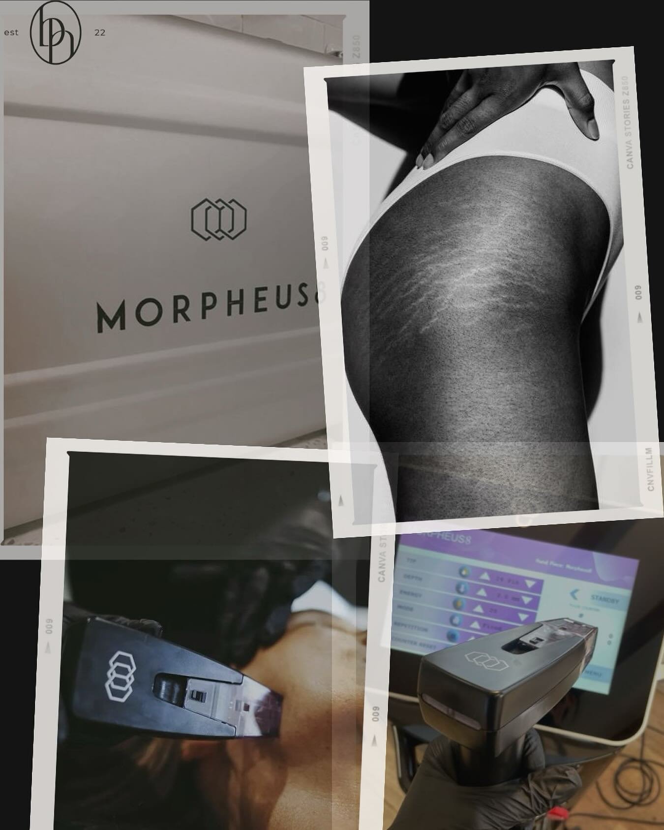 Benefits of Morpheus8 ⬇️

Skin Tightening: Morpheus8 is known for its ability to stimulate collagen production, leading to improved skin elasticity and firmness. This can be particularly beneficial for individuals experiencing sagging or loose skin.
