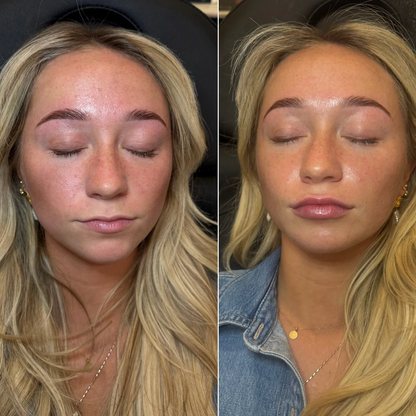 ✨ First-Time Filler Glow ✨
A soft, refined refresh &mdash; never overdone. 💉

This beauty began with &frac12; syringe of RHA&reg; 3 for a natural, balanced plump that enhances her features while maintaining harmony. We&rsquo;ll follow up in a few we