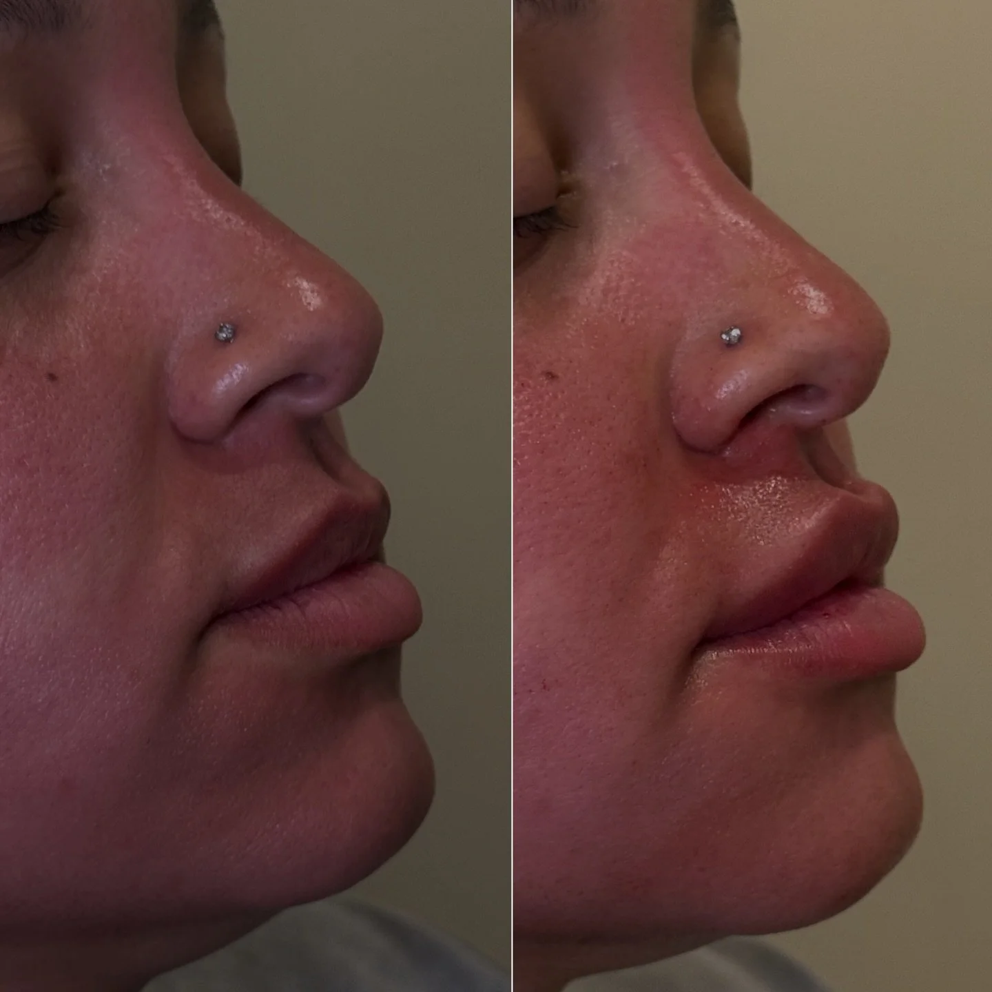 When you want to look like you, just a little more polished for your wedding day 🤍
This stunning bride came in for a soft lip enhancement ahead of her big day — giving her a natural, hydrated look that photographed beautifully.
Reminder: for