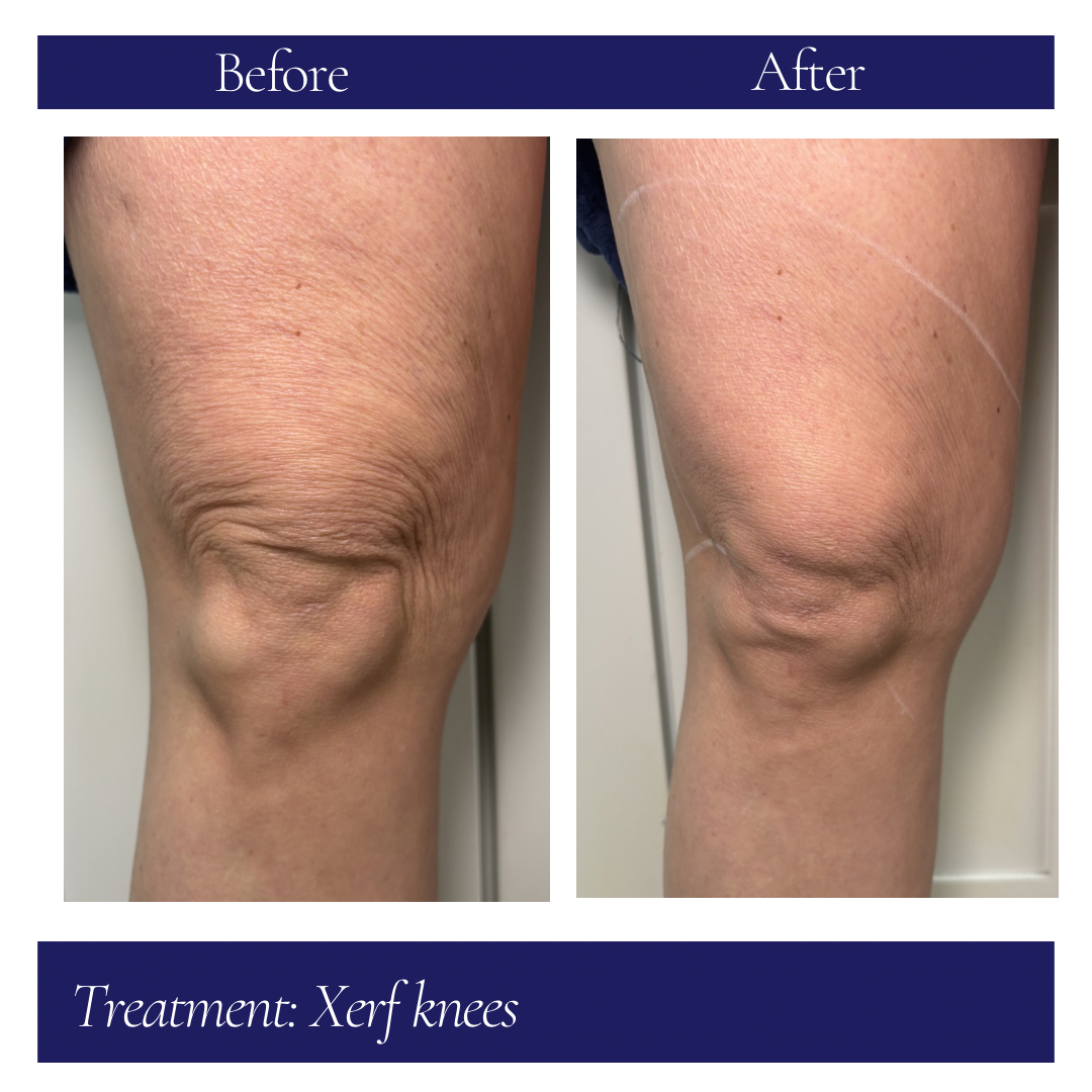 xerf b+a knees.PNG