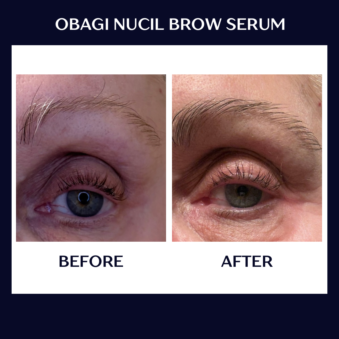 brow b+a.PNG