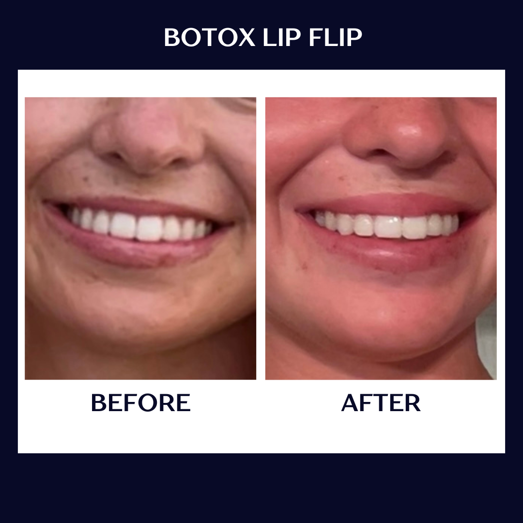lip flip b+a pic.PNG