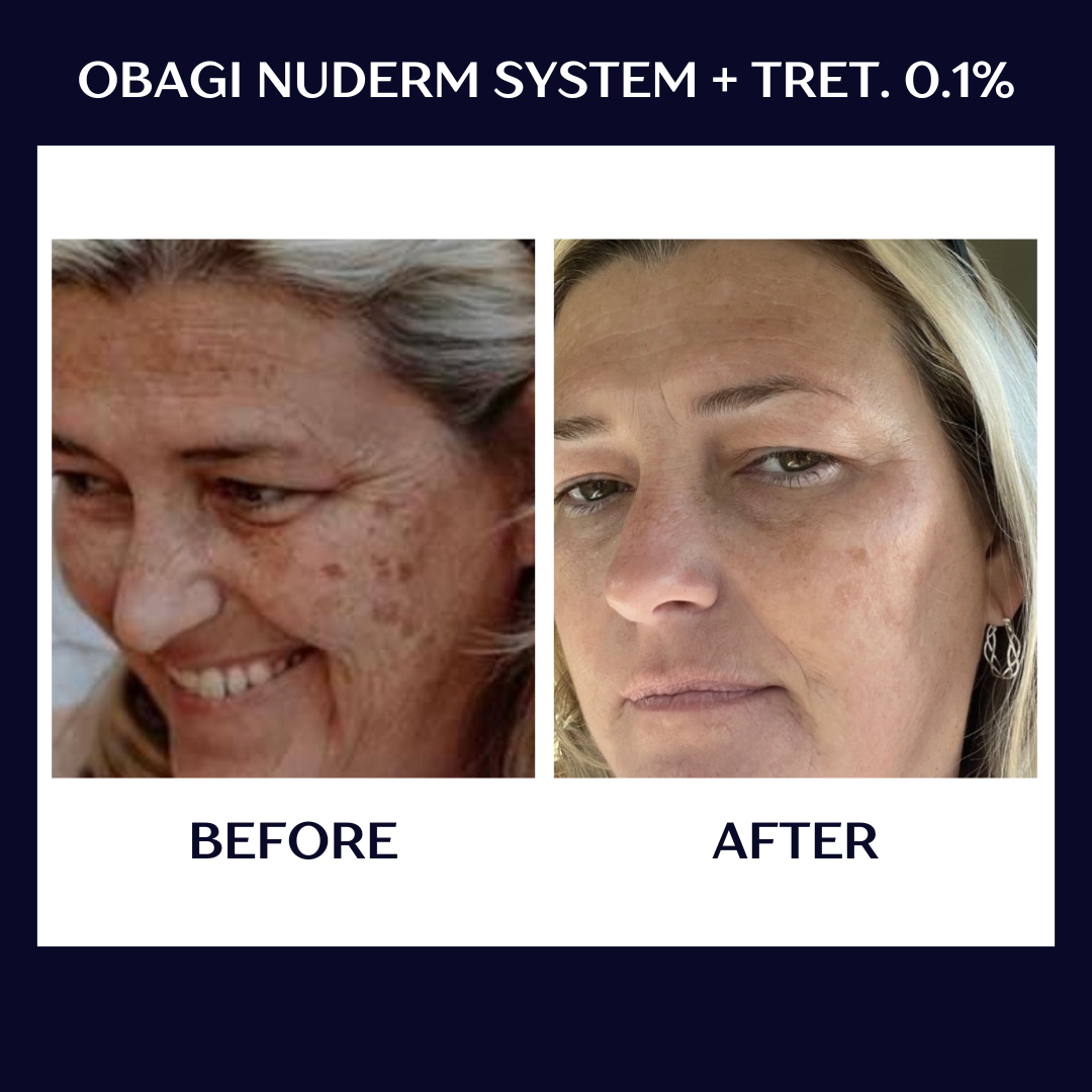 Obagi nuderm b+a.PNG