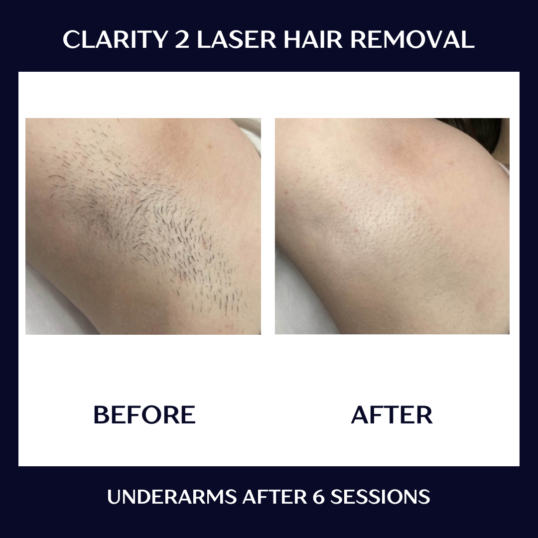 hair removal b+a.PNG