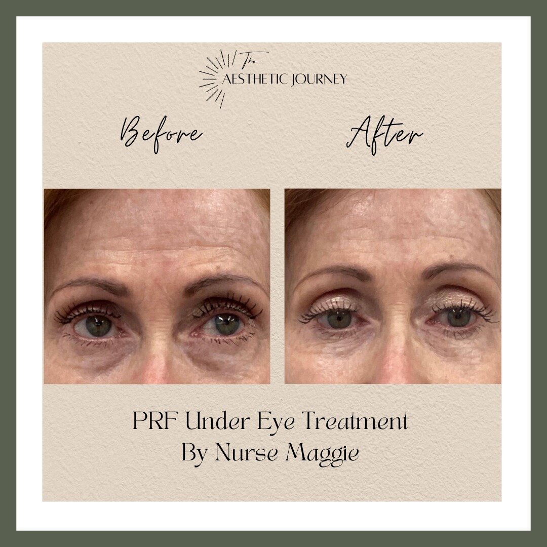 Before &amp; After with Nurse Maggie.✨
🌟 Witness the transformation! This before-and-after showcases the remarkable results of just one PRF under eye treatment. Dark circles and fine lines have visibly diminished, leaving the under-eye area looking 