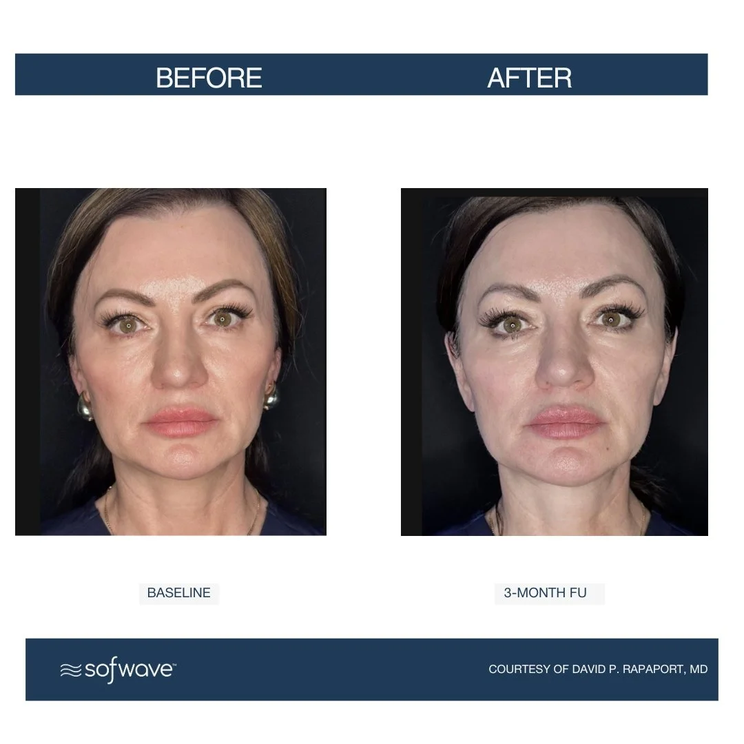 Face-Submental - Sofwave before and after.jpg