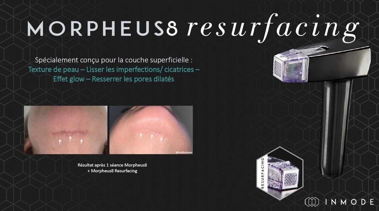 Tips Resurfacing 1.jpeg