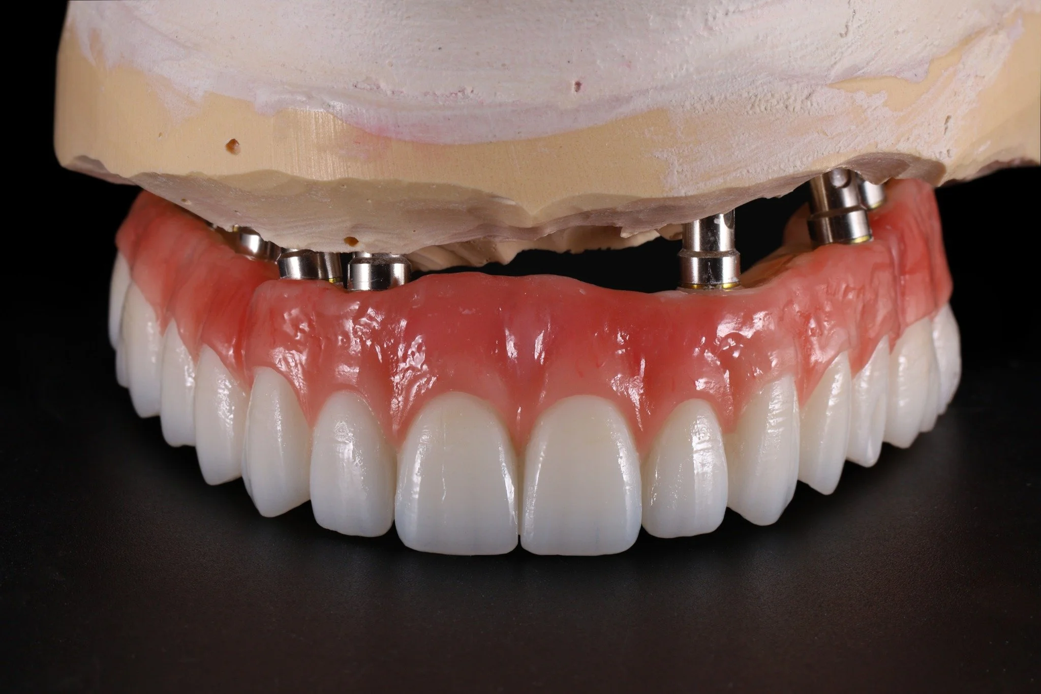 A real tough one! Beautiful 3 piece screw retained zirconia restoration. Worked closely with the talented @vahikpaulmeserkhani and the team at @la.dentists.group to get this case completed and delivered.