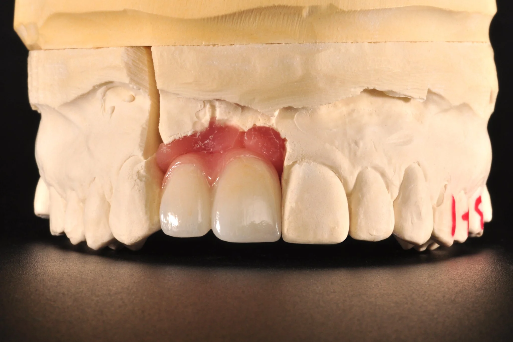 A beautiful anterior implant + cantilever to restore the gorgeous smile of this young patient. As part of our local services, a custom shade match was done to ensure perfection. ✨

Case started and completed by @vahikpaulmeserkhani at @la.dentists.gr