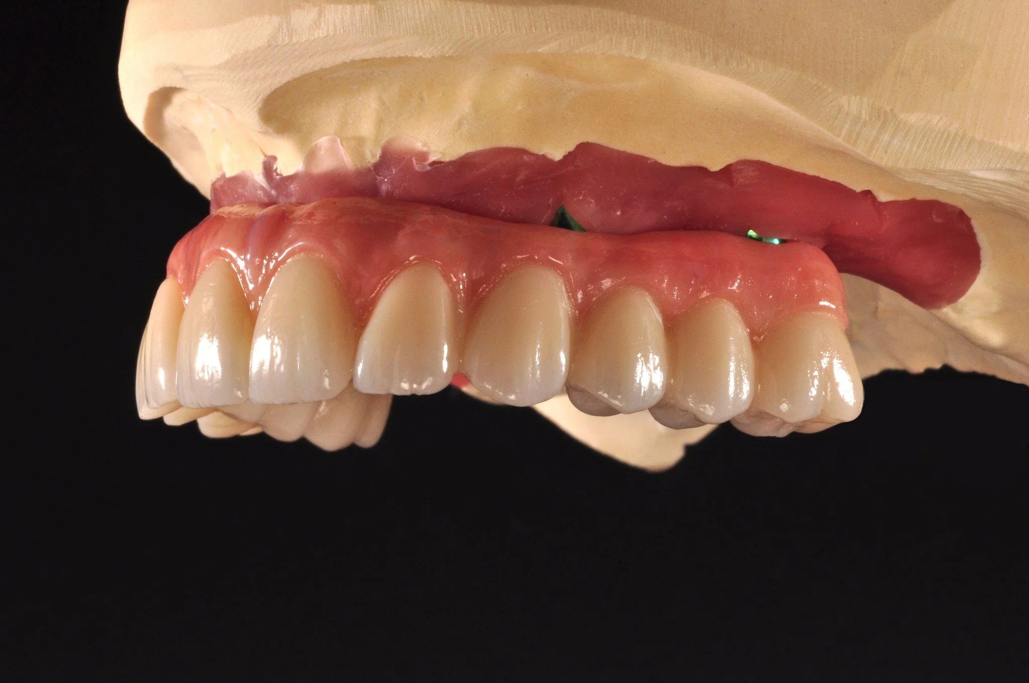 A detailed look at this gorgeous all-on-4 zirconia restoration. Treatment started and completed by Dr. Angela Sanabria of @dentalstudioofpasadena 

Looking for a lab to help plan and execute your next big implant case? Get in touch with our talented 