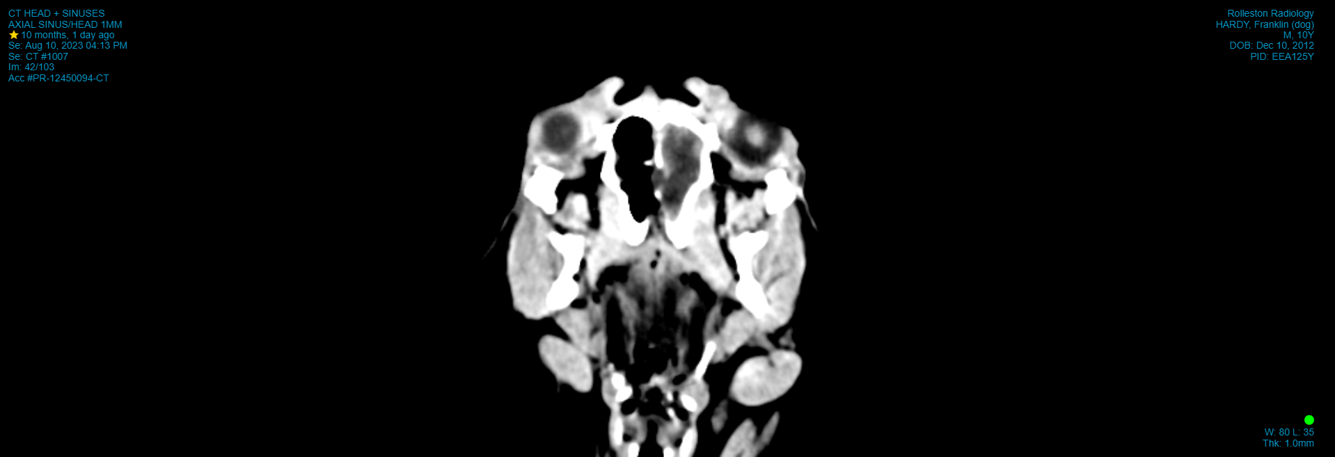 CT_CT HEAD + SINUSES_AXIAL SINUS_HEAD 1MM_2023-08-10.png