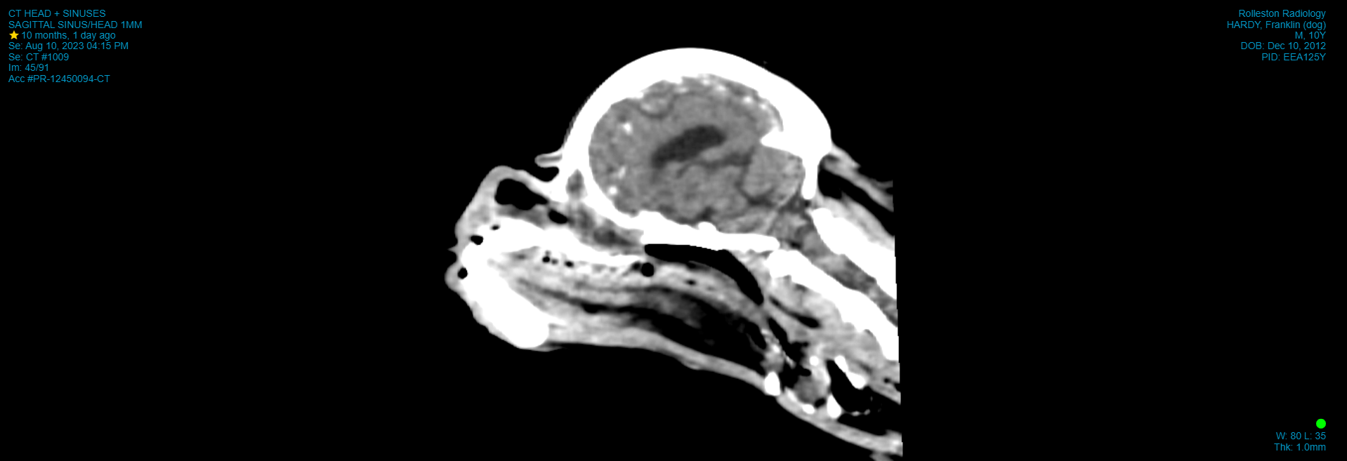 CT_CT HEAD + SINUSES_SAGITTAL SINUS_HEAD 1MM_2023-08-10.png