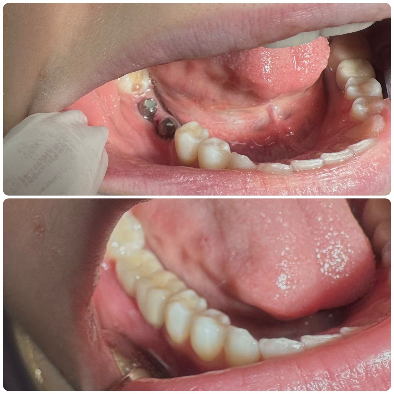 Close-up of a person's open mouth showing dental work with dental implants and healthy teeth and tongue.
