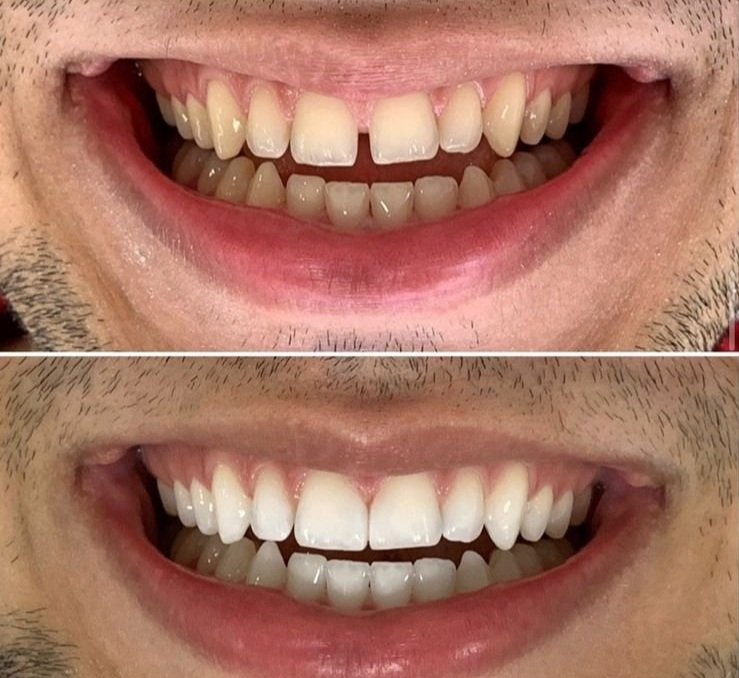 Comparison of a person's teeth before and after dental treatment, showing improved alignment and whitening.