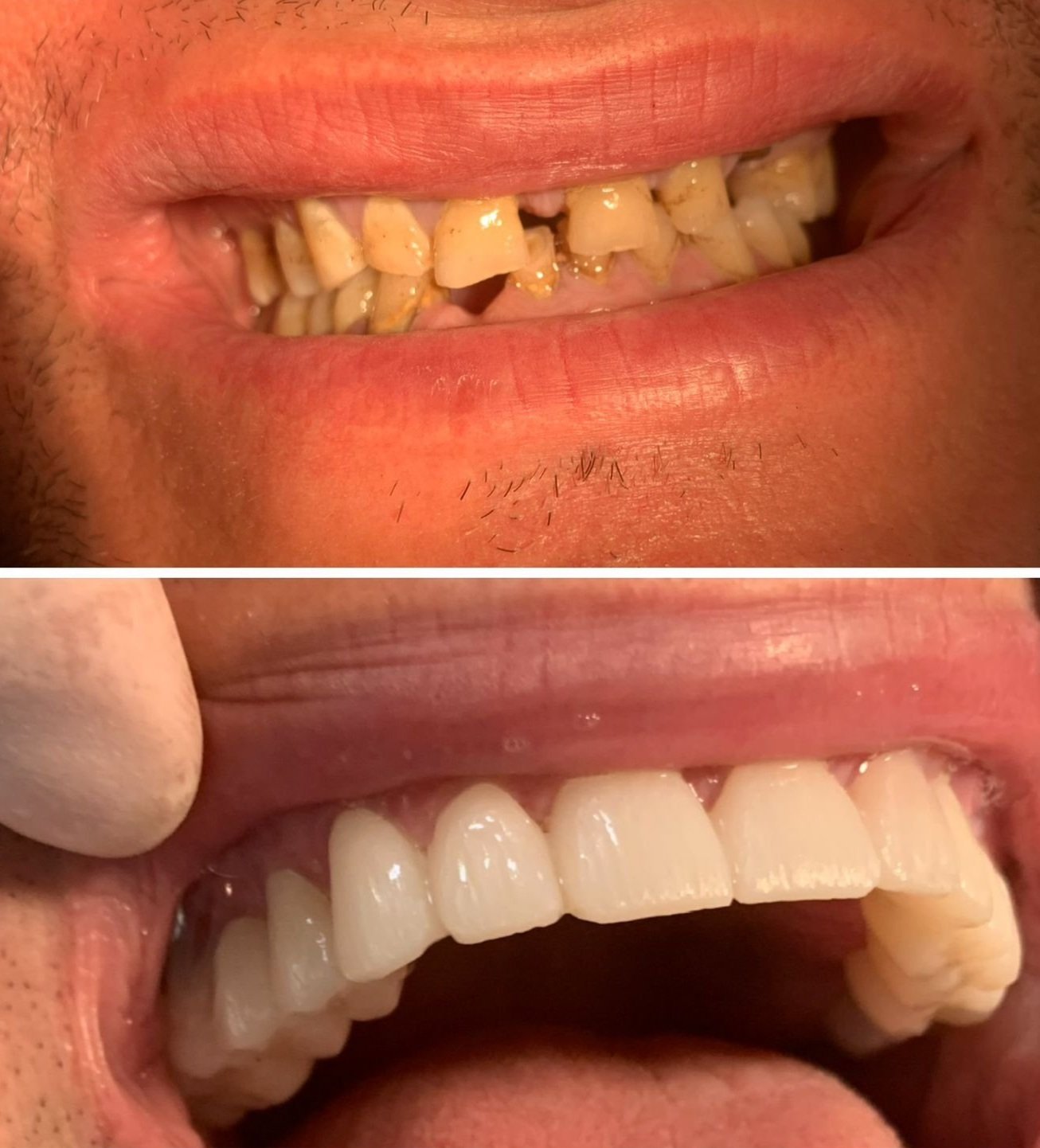 Comparison of teeth before and after dental treatment showing removal of decayed teeth and placement of new, healthy teeth.
