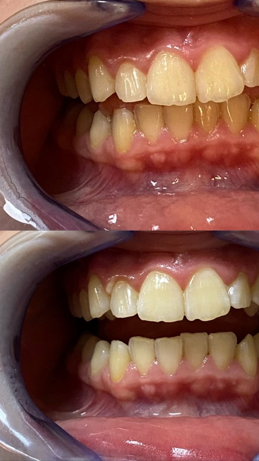 Comparison of teeth before and after dental cleaning or whitening, showing cleaner and whiter teeth in the bottom image.