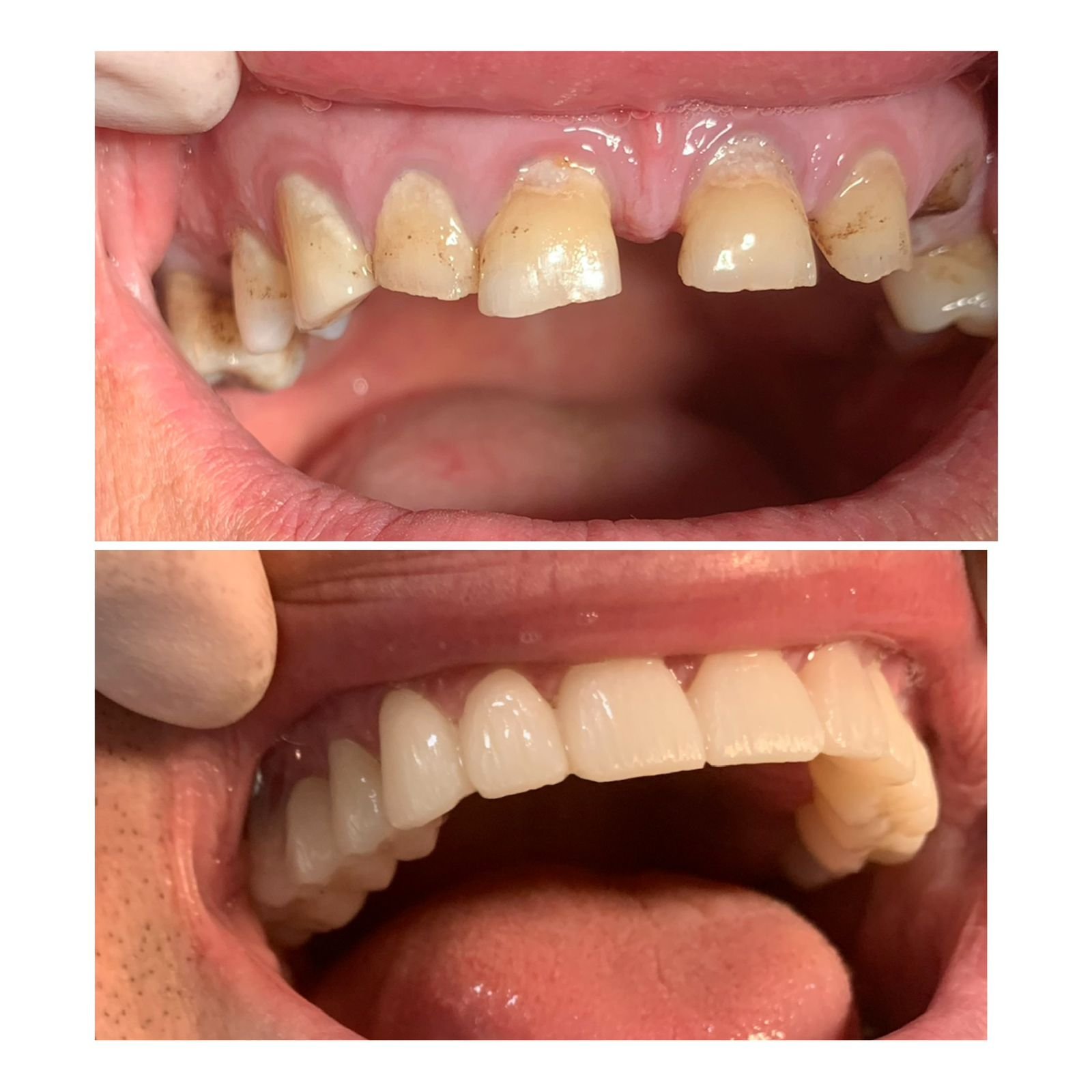 Comparison of stained and decayed teeth in the top image with clean, healthy teeth in the bottom image.