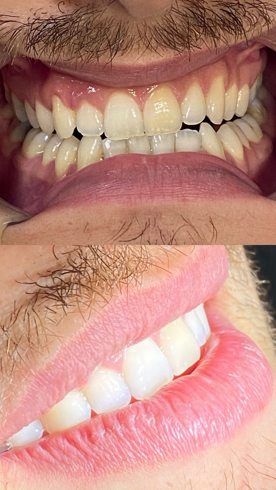 Close-up of a person's smile showing upper and lower teeth, with lips slightly parted, and a partial view of the mustache above the upper lip.