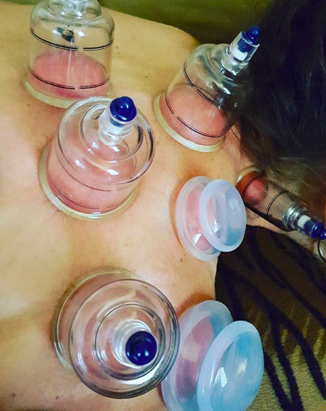cupping-therapy-5.png