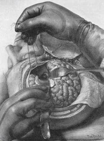 Brodel drawing of a Harvey Cushing brain tumor operation