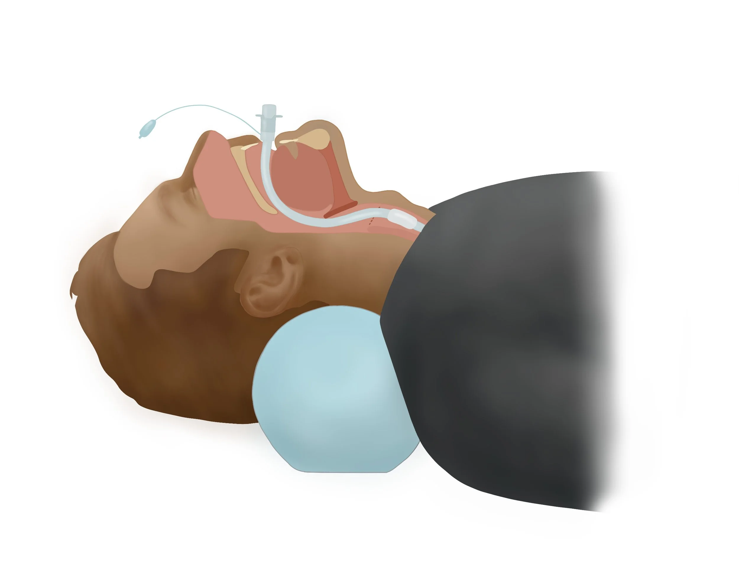 Endotracheal Tube Final Illustration