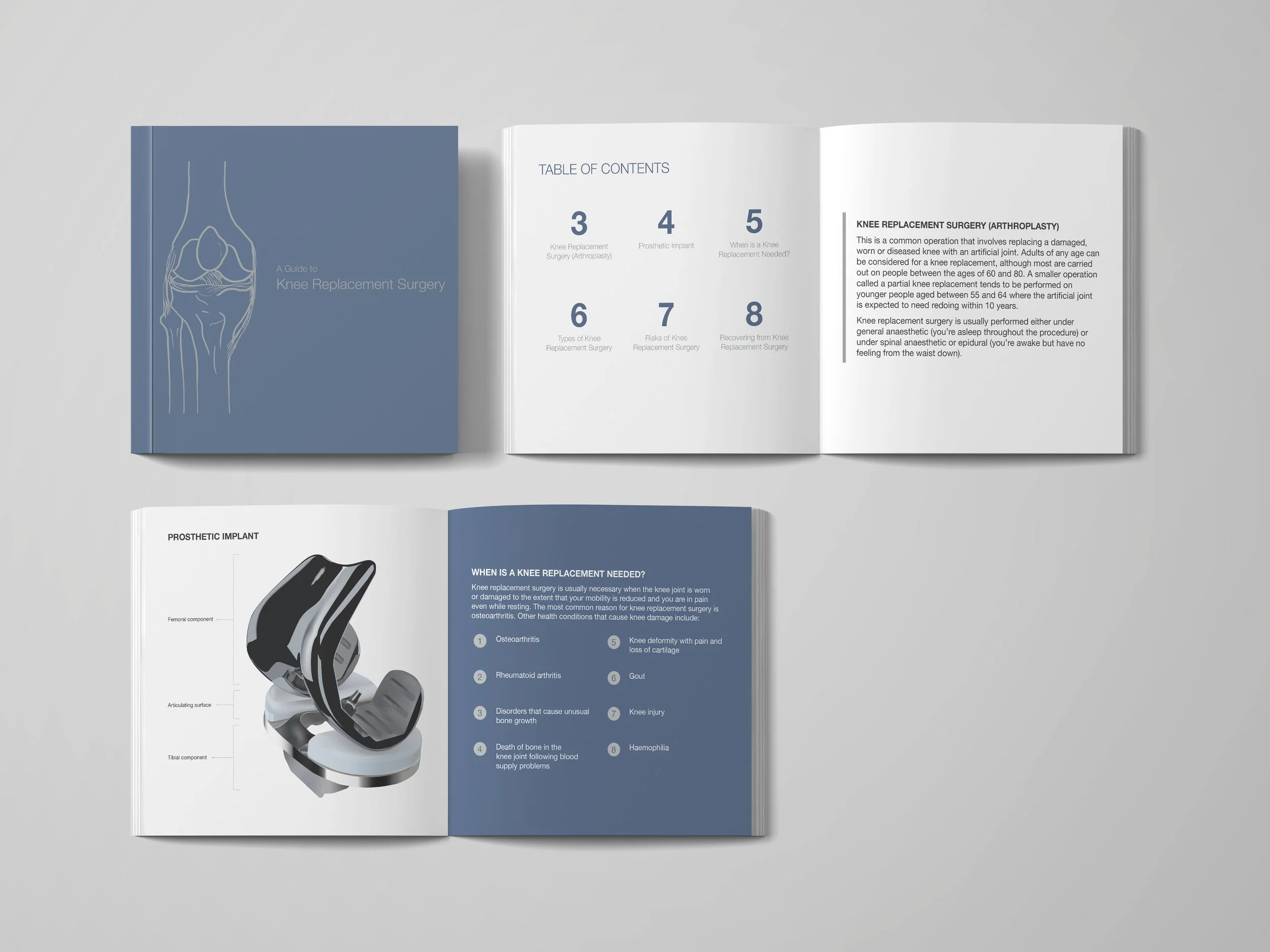 Blue square book about knee replacement surgery with hand drawn knee on the cover, a table of contents page, overview of knee replacement surgery, image of prosthetic, and why a knee replacement is needed.