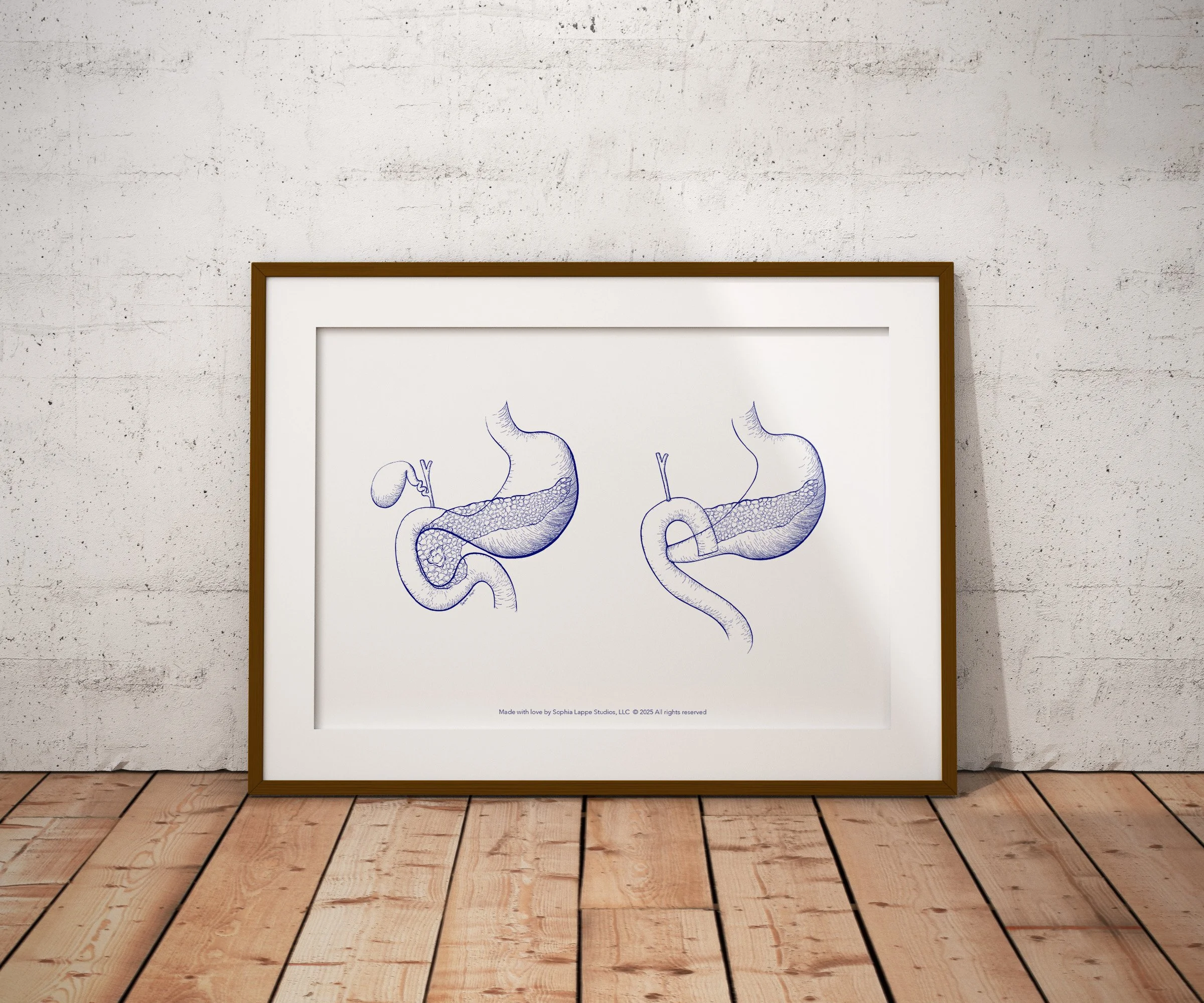 Whipple surgery poster shown in a styled mockup.