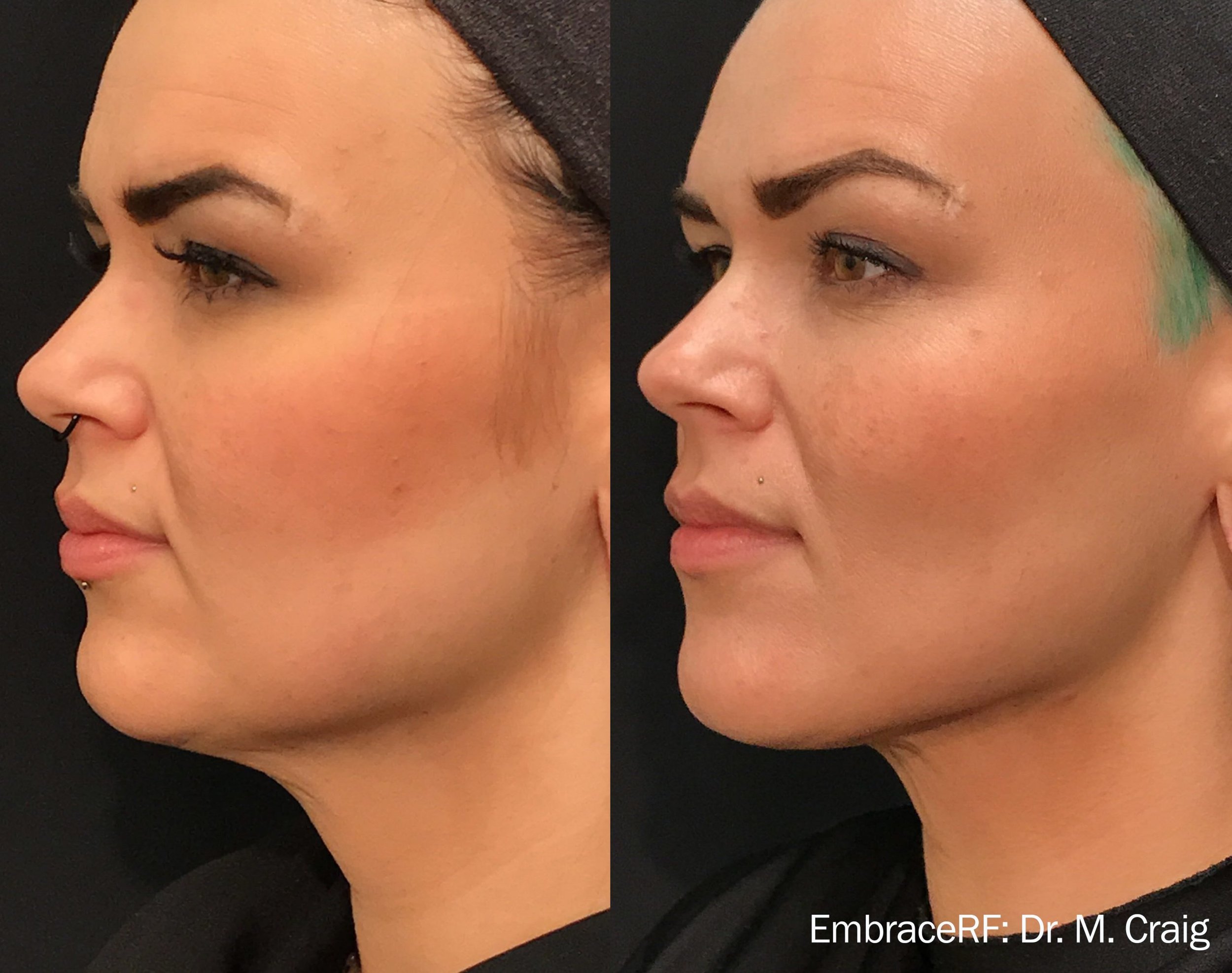 embracerf-before-after-dr-m-craig-preview-1.jpg