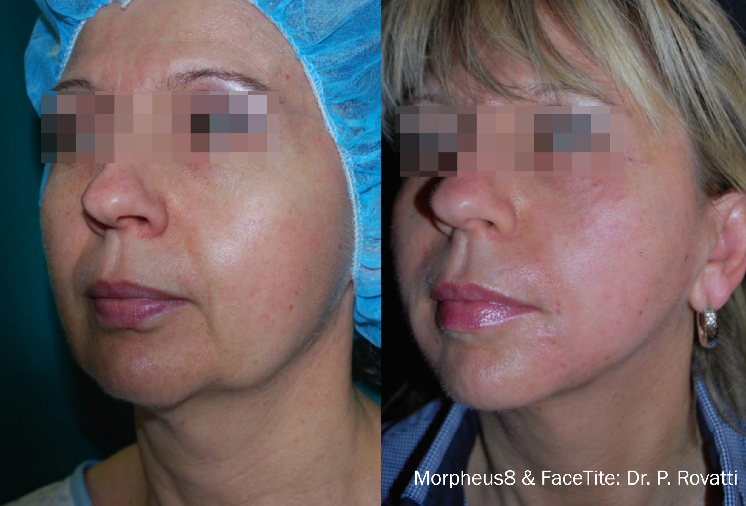 morpheus-facetite-before-after-dr-p-rovatti-preview-1.jpg