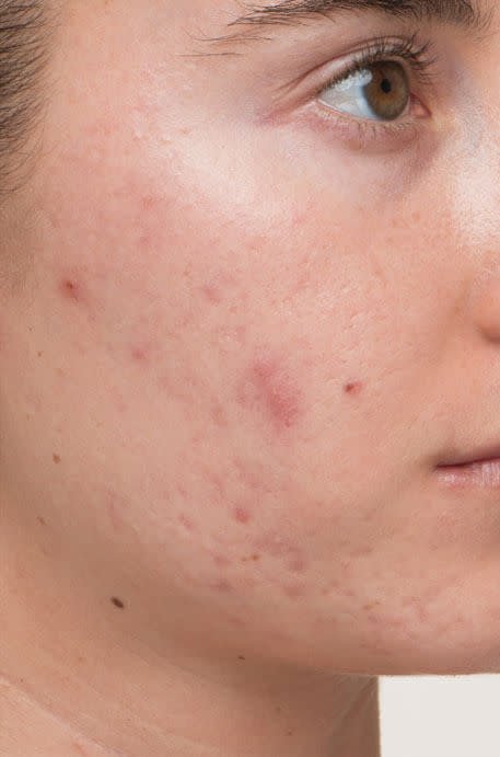acne before.jpg