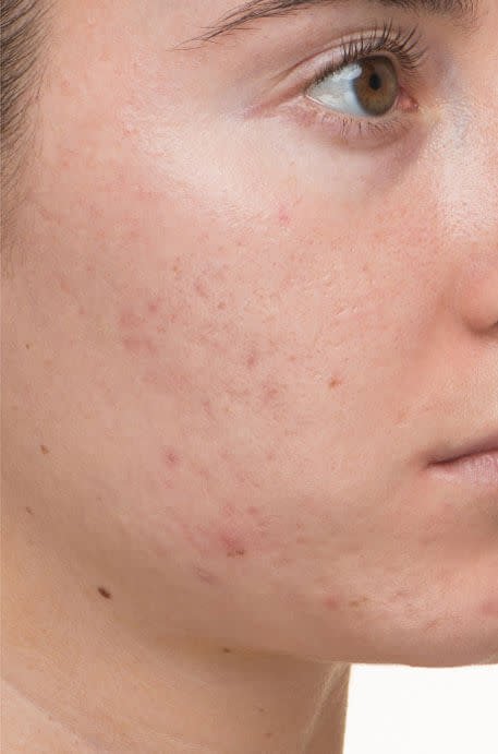acne after.jpg