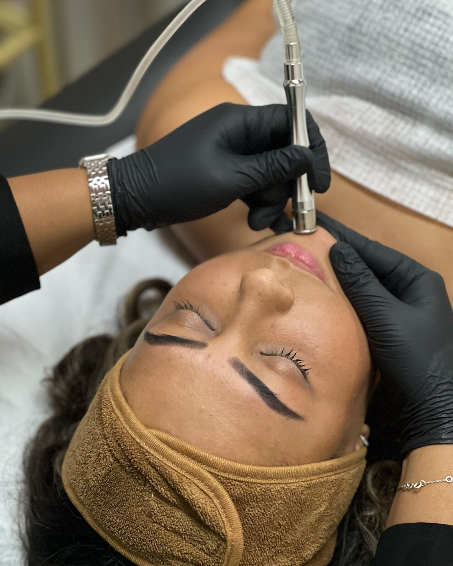 ✨Glow up with our Microdermabrasion Magic! ✨ Unveil smoother, radiant skin as our microdermabrasion treatment buffs away those dull layers. Say goodbye to rough texture and hello to a fresh, rejuvenated complexion. 🌞

Vitamin C available as an add-o