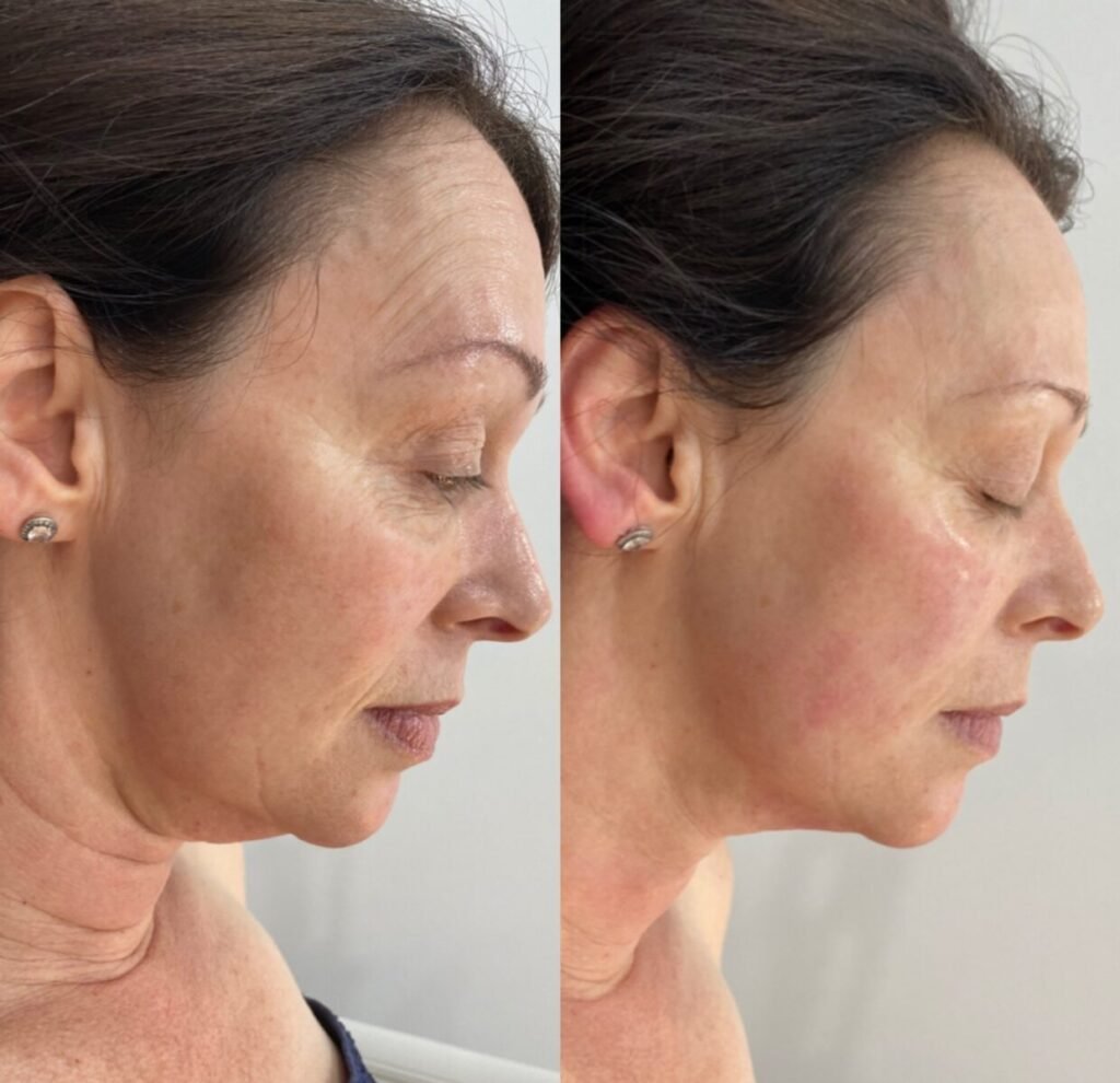 HIFU-Before-and-After-01-e1628244716112-1024x990-1.jpeg