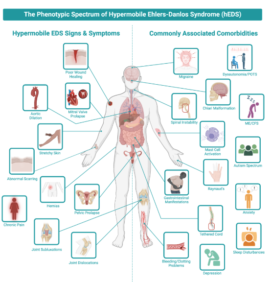 Ehlors-Danlos Syndrome: A Physical Therapy Perspective