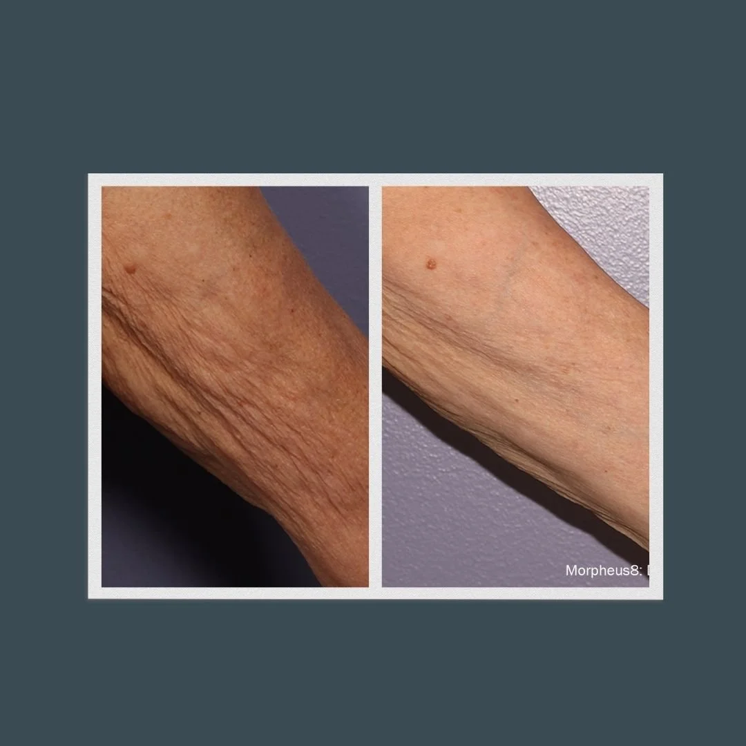 Before and after picture of a woman's bicep who used Morpheus8 treatment.