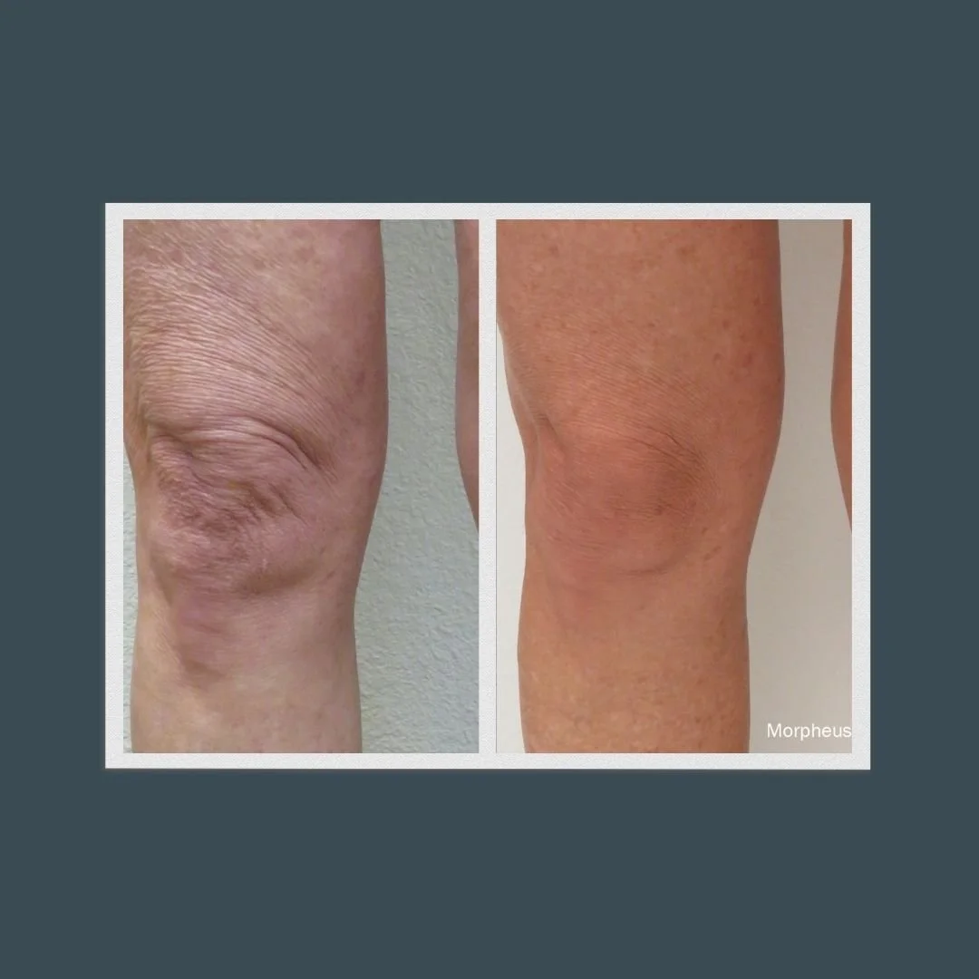 Before and after photo of a person's right leg that had Morpheus8 treatment