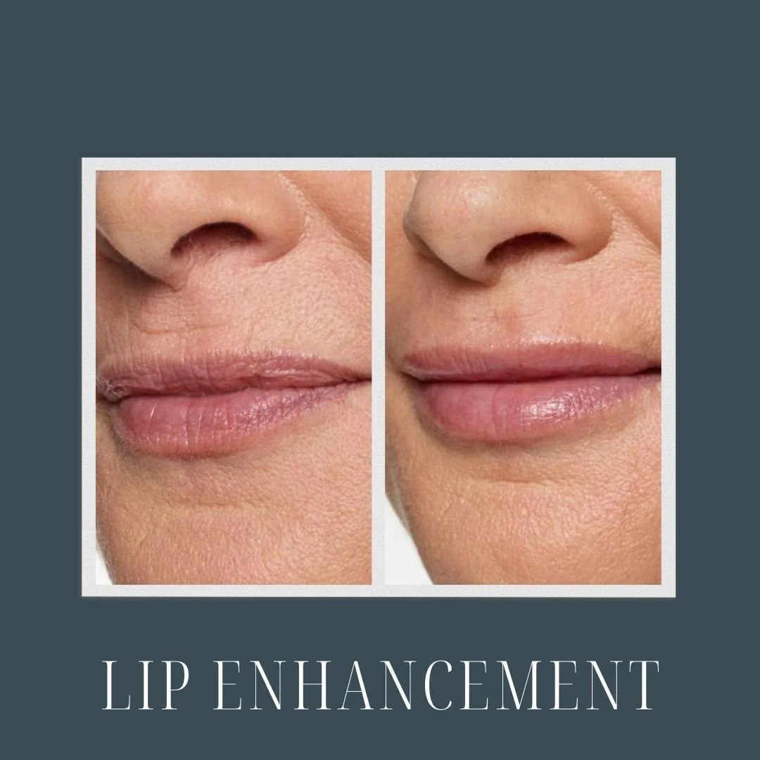 before and after picture of a woman who received dermal filler on her lips