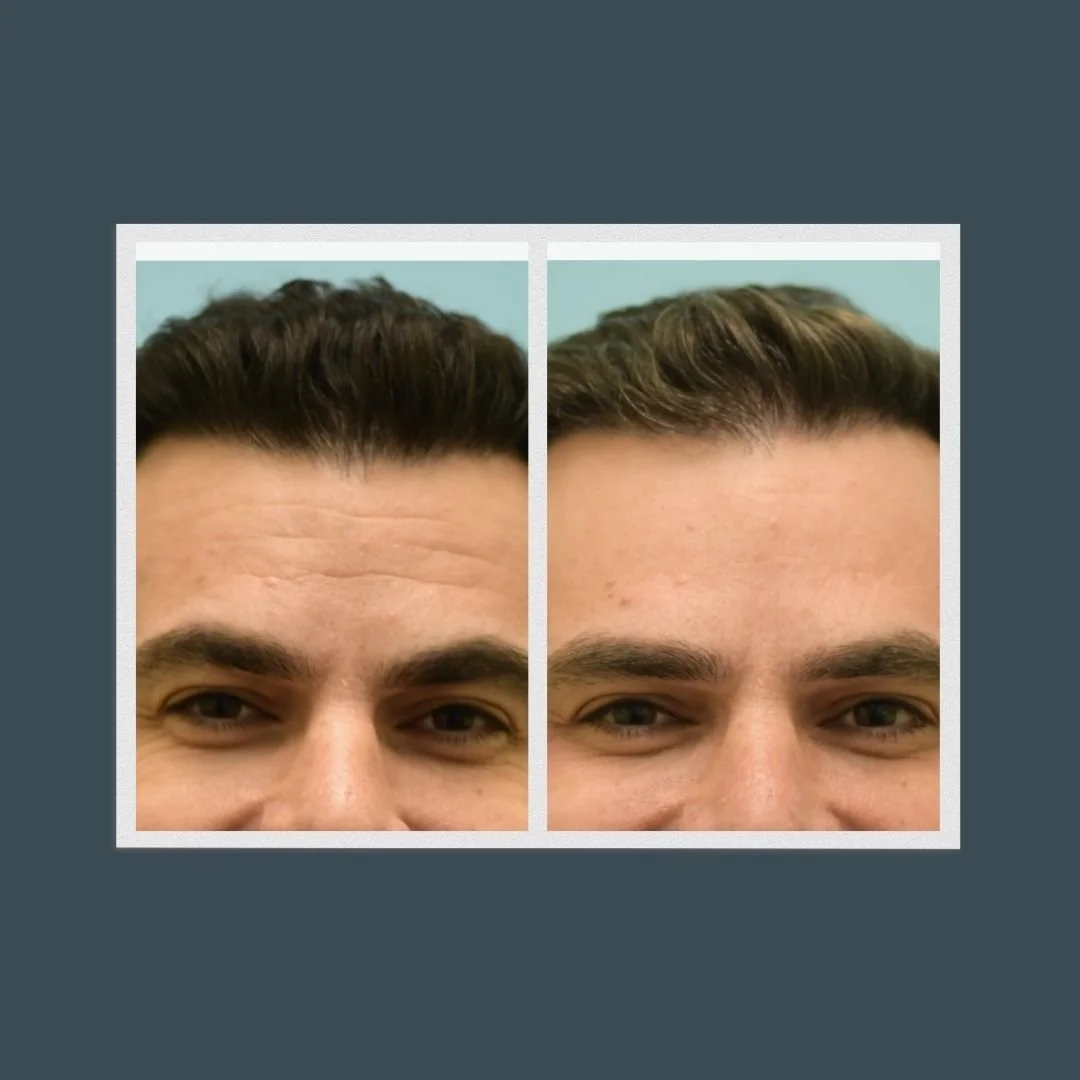 A side-by-side before and after picture of a man who received dysport treatment