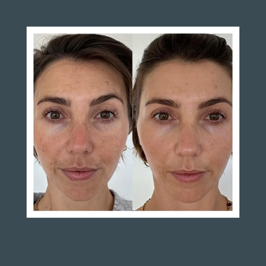 Before and after picture of a woman who received microneedling treatment