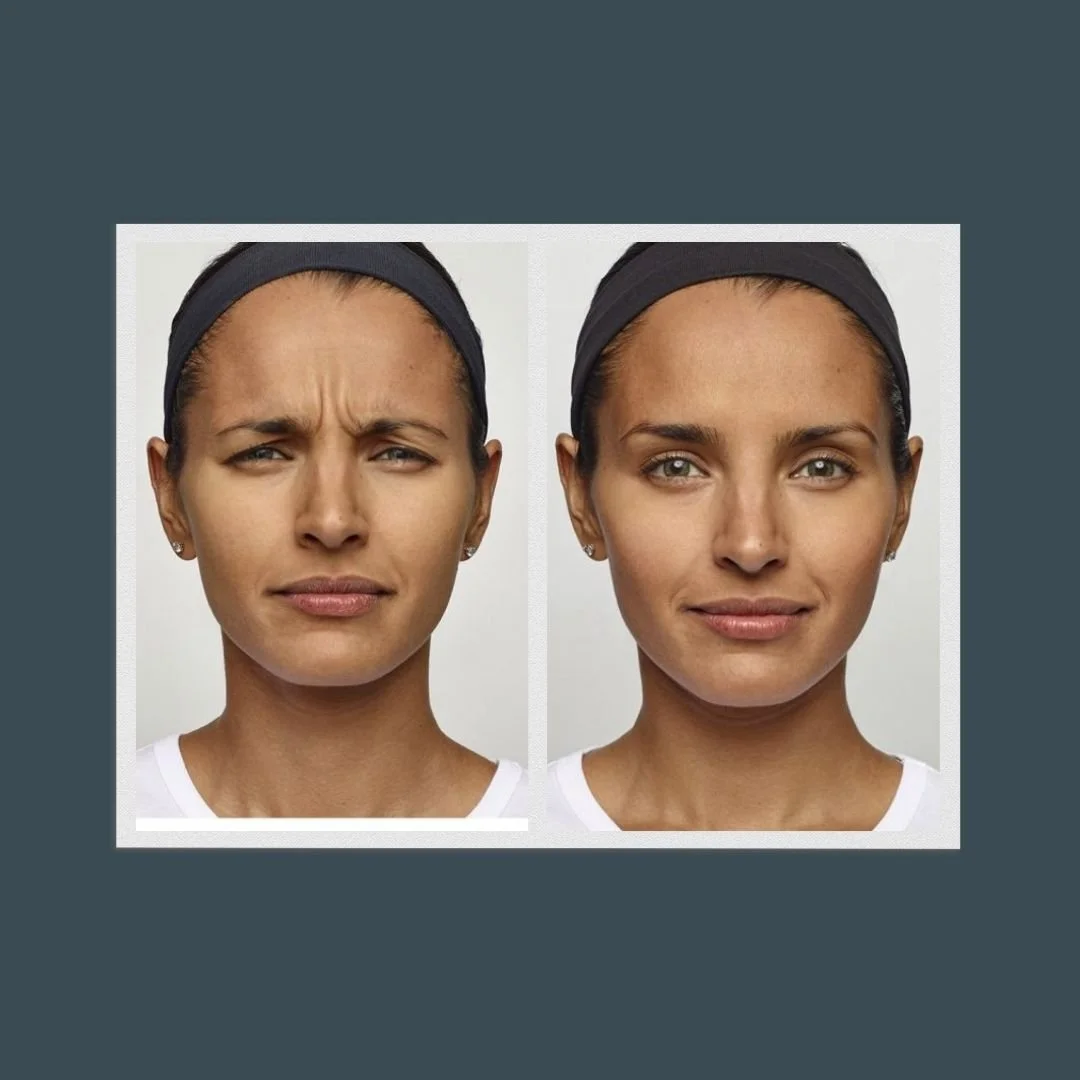 side-by-side before and after picture of a woman who got a jeuveau treatment on her 11s
