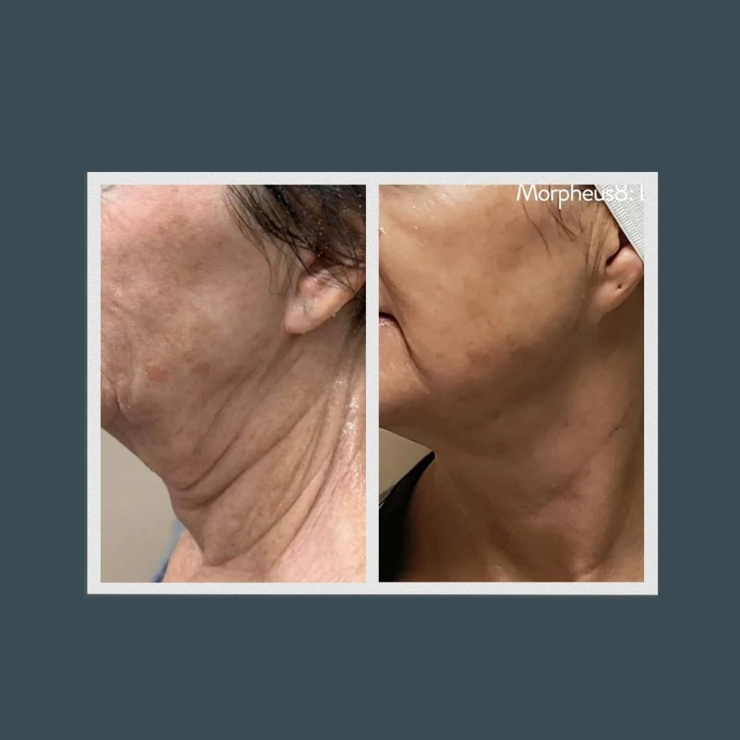 Before and after picture of the side of a woman's face who received Morpheus8 treatment