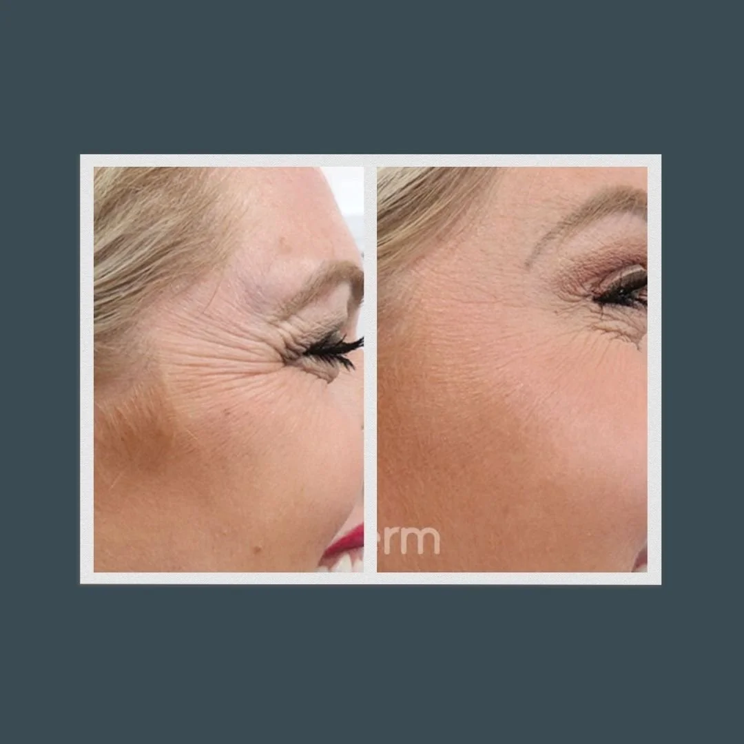 Side-by-side before and after picture of a women's crows feet who received jeuveau injections