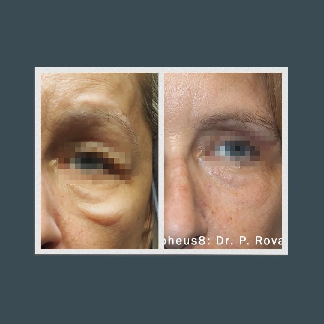 Before and after pictures of the side of a woman's face who received Morpeus8 treatments
