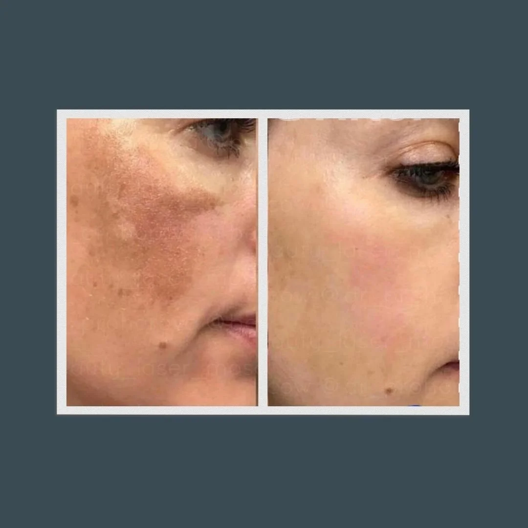 Before and after picture of a woman's profile who received a chemical peel