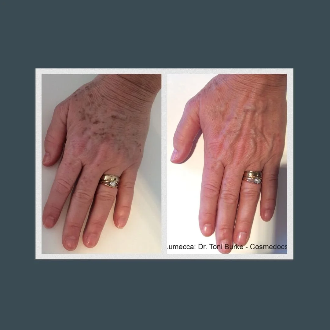 Before and after picture of a woman's left hand who received lumecca dark spot removal. Visibly less sun damage and signs of aging