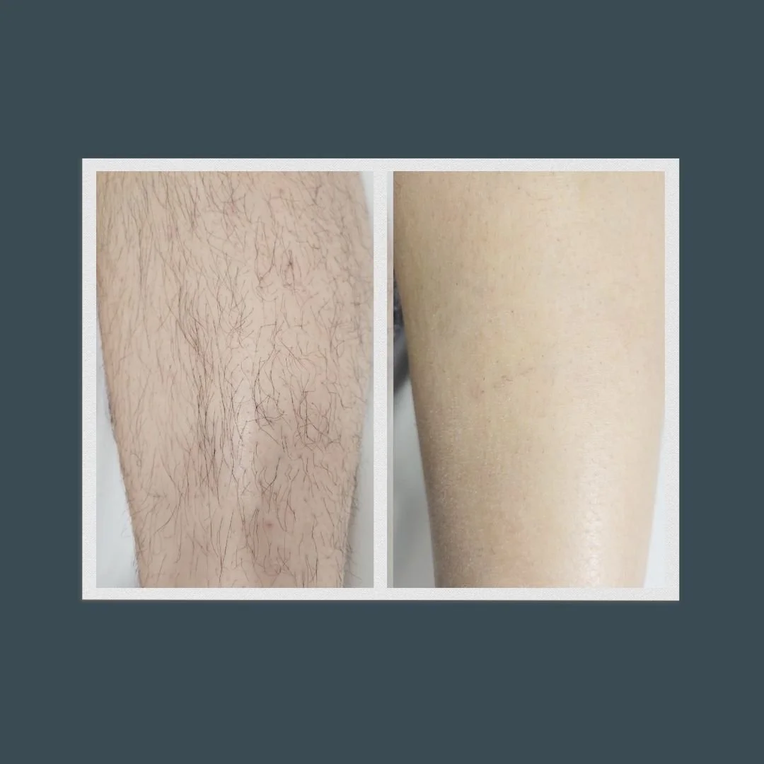 Before and after picture of a person's calf who received laser hair removal