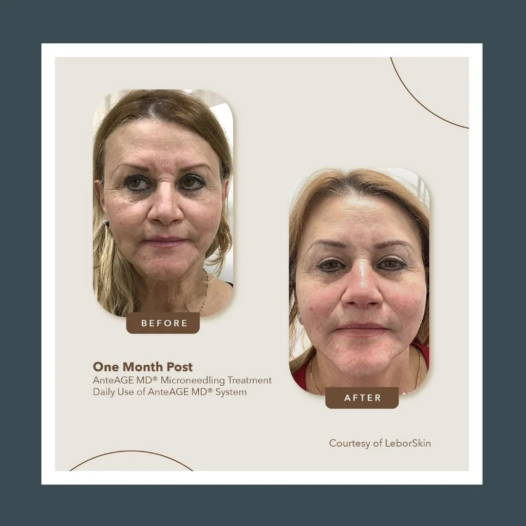 Before and after picture of a women who received AnteAGE microneedling treatment