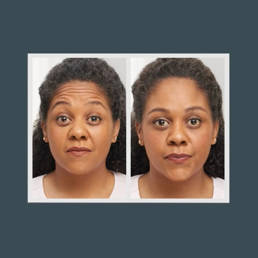 Side-by-side of a woman who received jeuveau injections