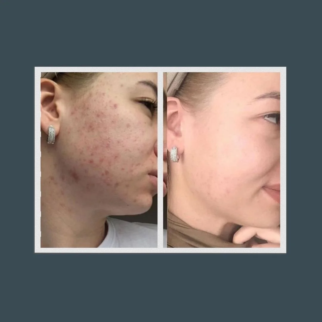 Before and after picture of a woman who received a chemical peel. She has noticeably less acne scaring. 
