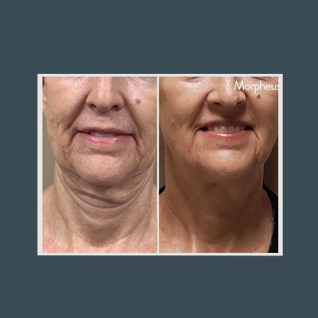 Before and after picture of a woman's face and neck who received Morpheus8 treatment
